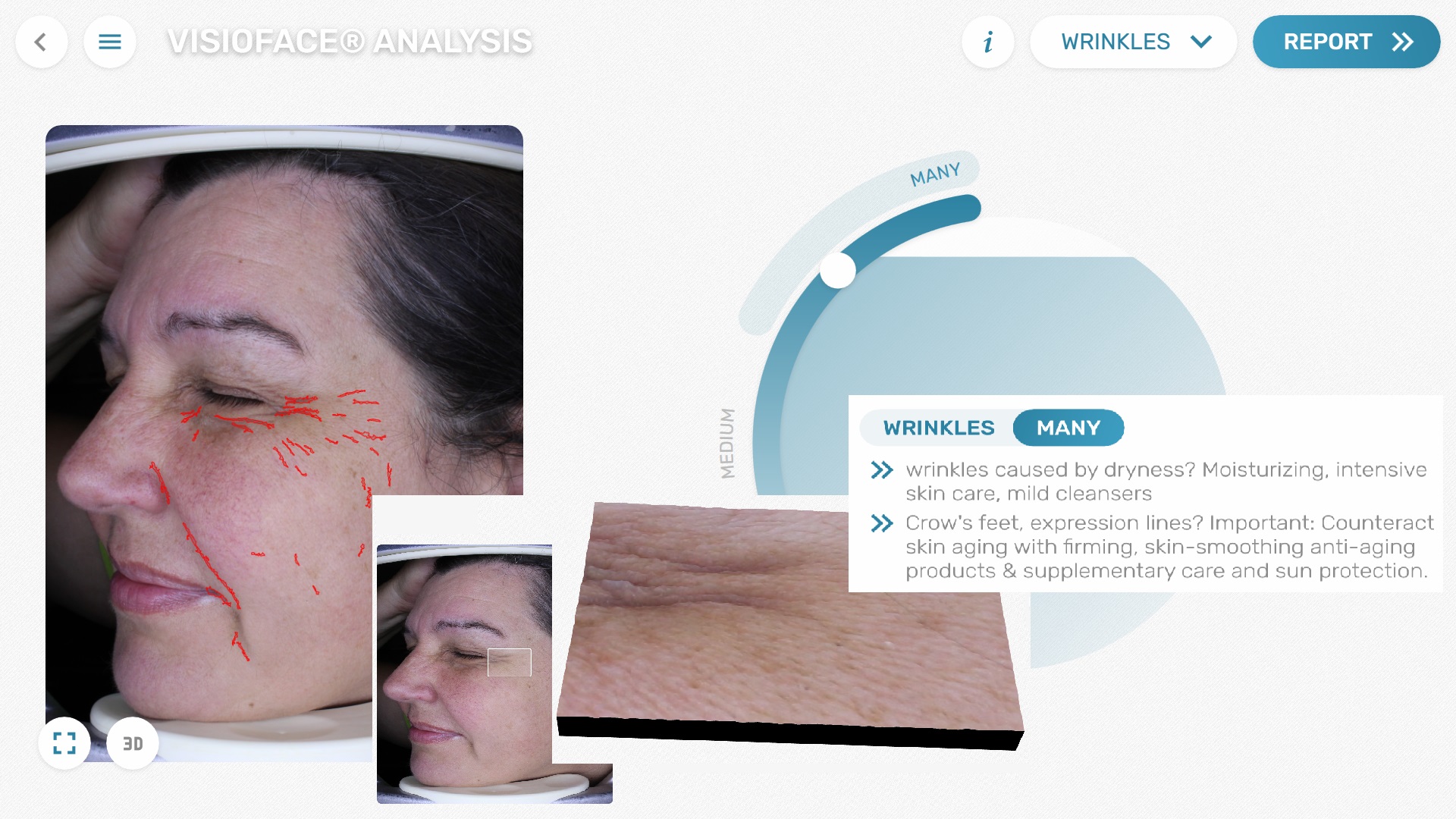 VisioFace® - analysis of lines & wrinkles, partial "3D" animation