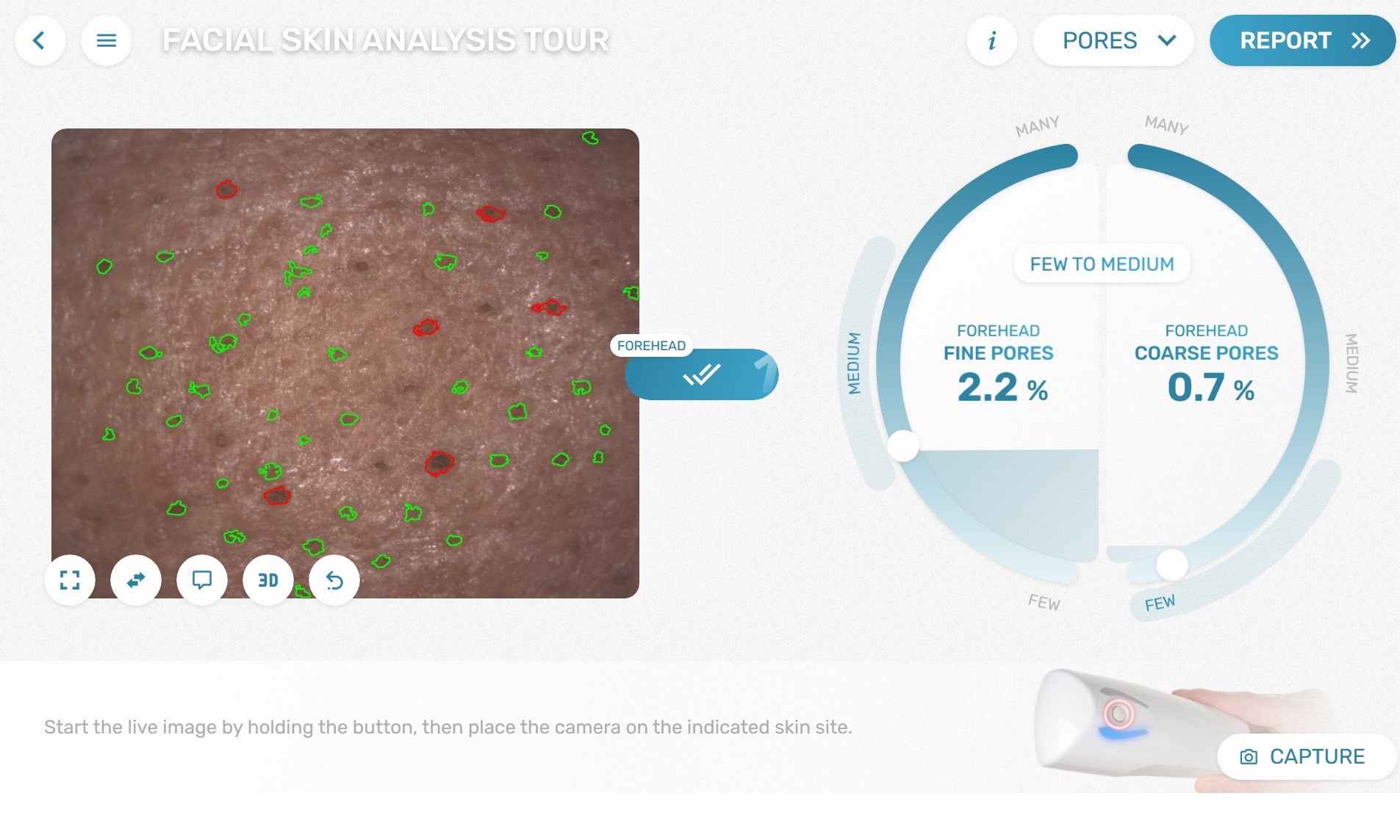 coarse and fine pore detection with the Visioscope®