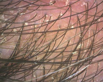 dandruff and redness on scalp