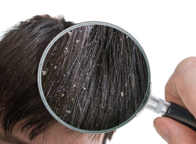 DandruffMeter - investigate dandruff according to size and number
